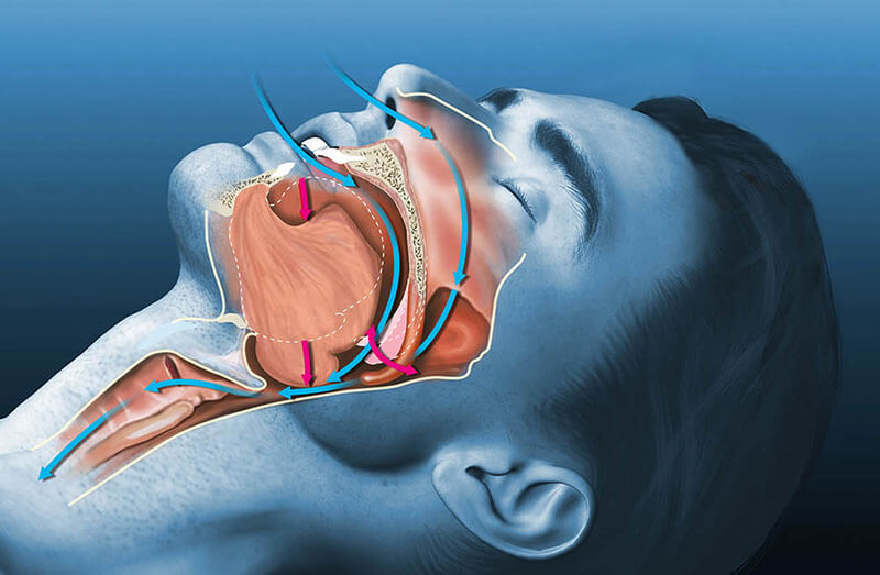 Train Your Mouth to Stop Snoring